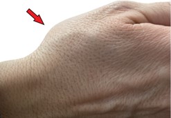 Ολική αρθροπλαστική αντίχειρα σύγχρονη επεμβατική μέθοδος αντιμετώπισης της αρθρίτιδας της βάσης του αντίχειρα
