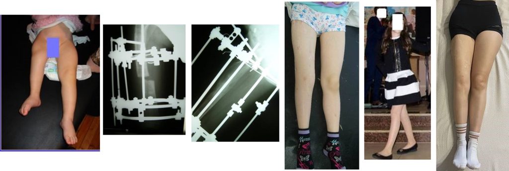 ΕΠΙΜΗΚΥΝΣΗ ΤΩΝ ΟΣΤΩΝ ΜΕ ΔΙΑΤΑΤΙΚΗ ΟΣΤΕΟΓΕΝΕΣΗ